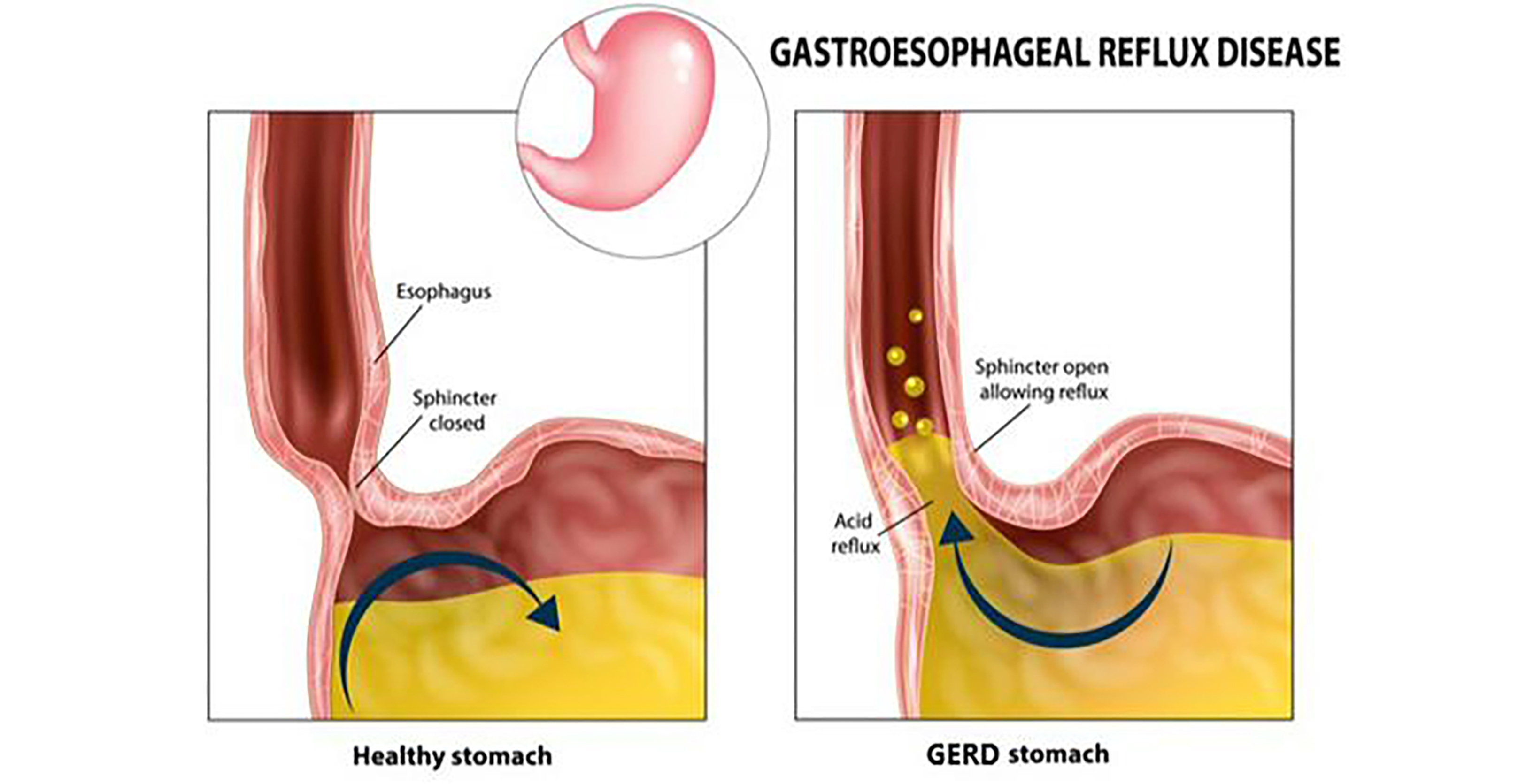 Healthy Her Gastroesophageal Reflux Disease